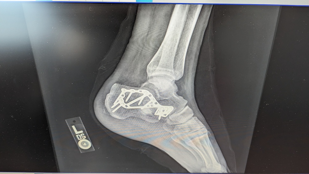 Lisfranc Fracture - Motus Physical Therapy