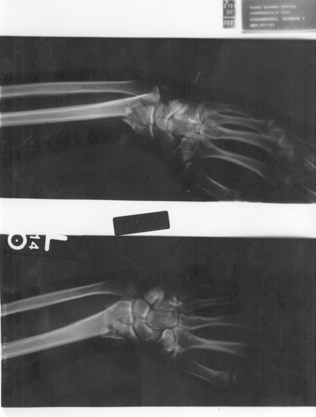 Left wrist after bike crash 7/2002