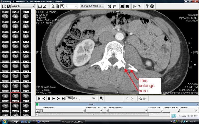 One of my left transverse processes off partying by itself....