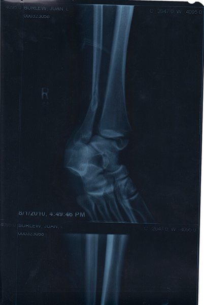 Tibula fracture