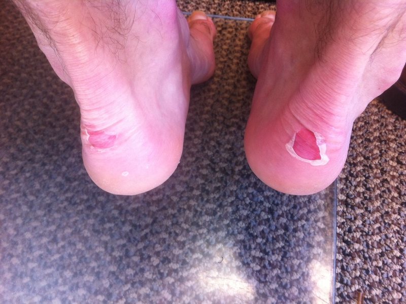 blisters