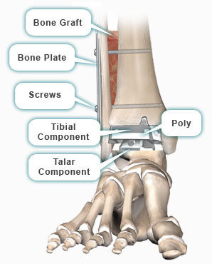 total ankle replacement