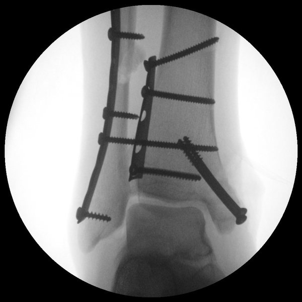 Syndesmotic screw removal after broken ankle?