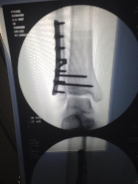 Plates and screws