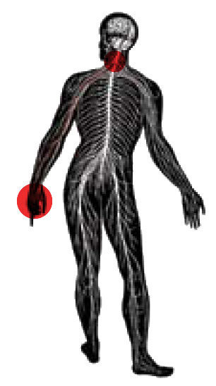 Thoracic Outlet Syndrome