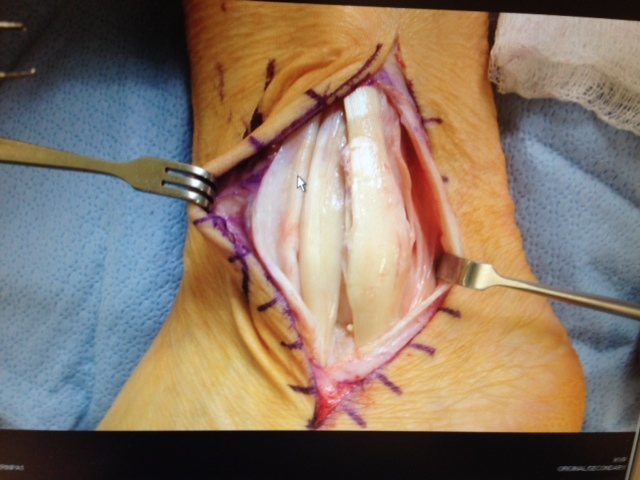 left outside ankle, toes to the left ... flattened peroneous longus and brevis, overe the yop of the ankle bone instead of behind it ... should be behind the retinaculum, not in front of it