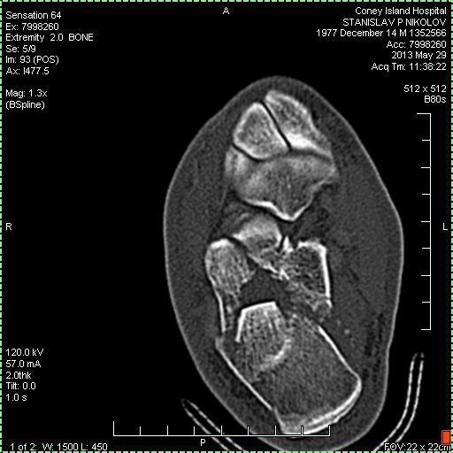 CT scan of sub-talar joint disrupture