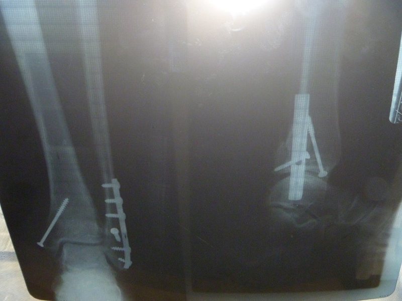 my  robo ankle