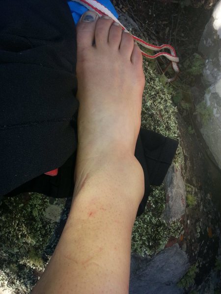 Fractured Talus injury 20 minutes after falling 10-12 feet onto lots of rocks