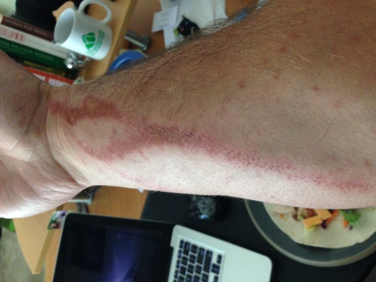 Proof the rash does exist.  Photo credit:  cserenari