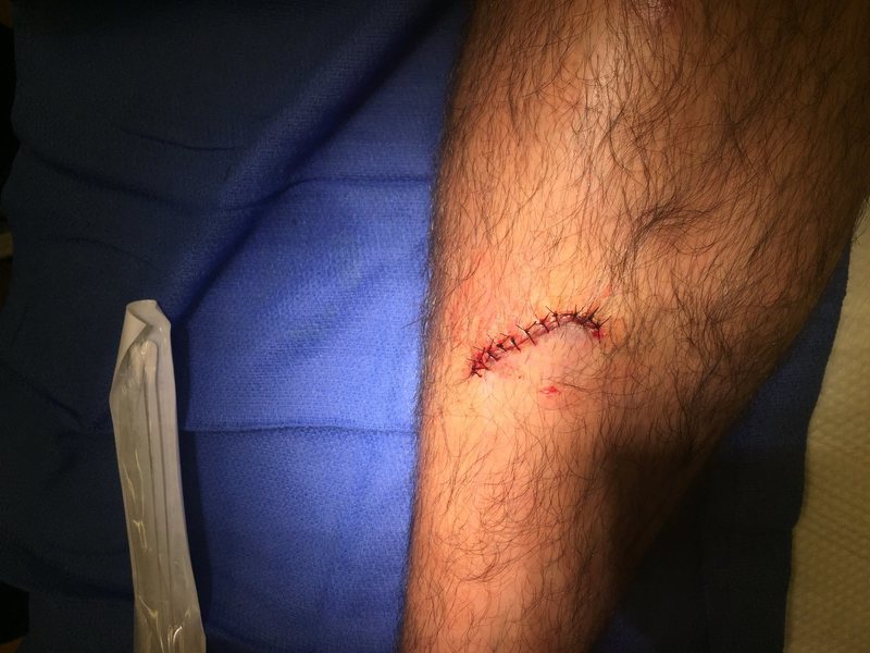 14 stitches later and the leg is good. 